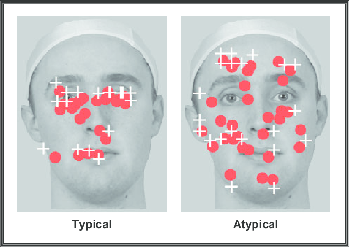 Overlay of eye tracking data on face.Data illustrate the relative difference in the number of eye movements produced under typical versus atypical scan path conditions. Each red sphere represents a fixation by the participant, while the white crosshairs mark the locations to which the fixation cross moved during the run.(Morris et al., 2007)